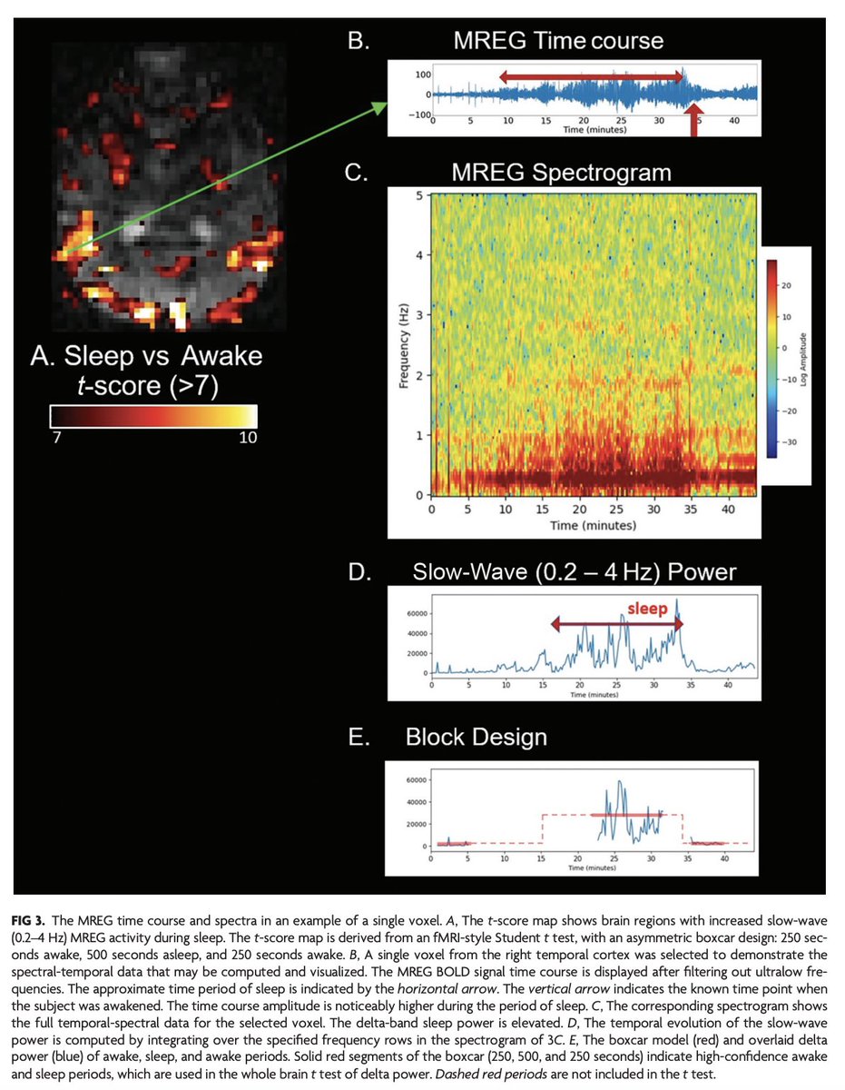 "Delta Wave MRI: fMRI of Electrophysiologic Activity"

doi.org/10.3174/ajnr.A…