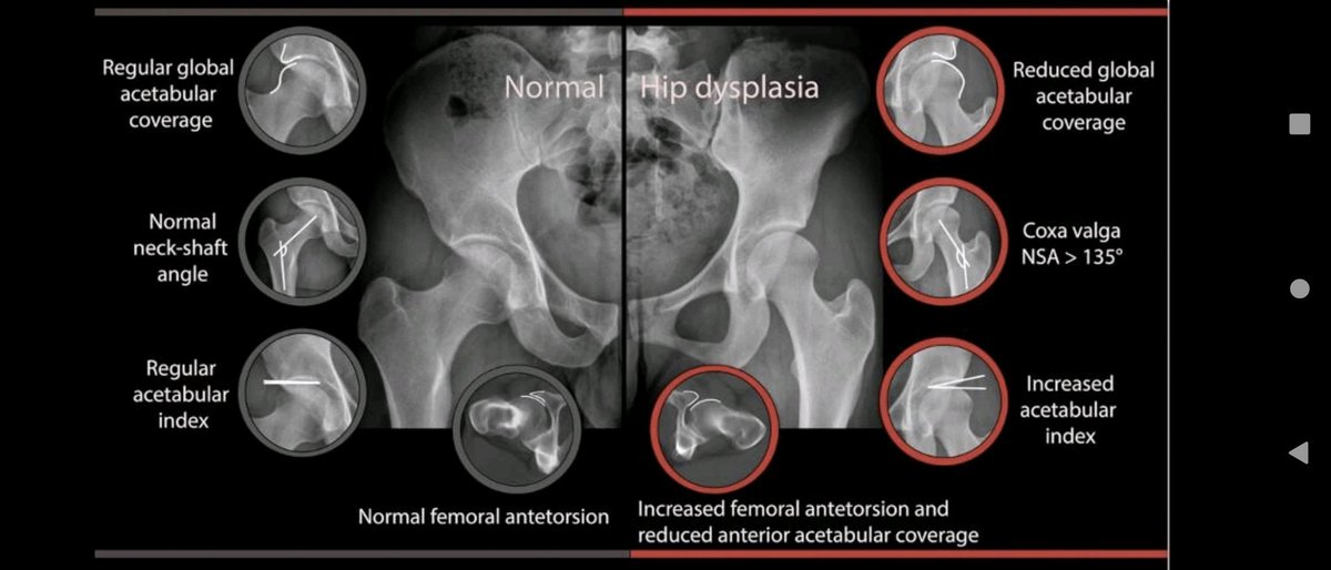 Sᴡɪss Uʟᴛʀᴀsᴏᴜɴᴅ Cᴇɴᴛᴇʀ - UZR (@rheumatology) on Twitter photo Hip Microinstability: New Concepts and Comprehensive Imaging Evaluation
pubs.rsna.org/doi/10.1148/rg… Hip Microinstability: New Concepts and Comprehensive Imaging Evaluation
pubs.rsna.org/doi/10.1148/rg…