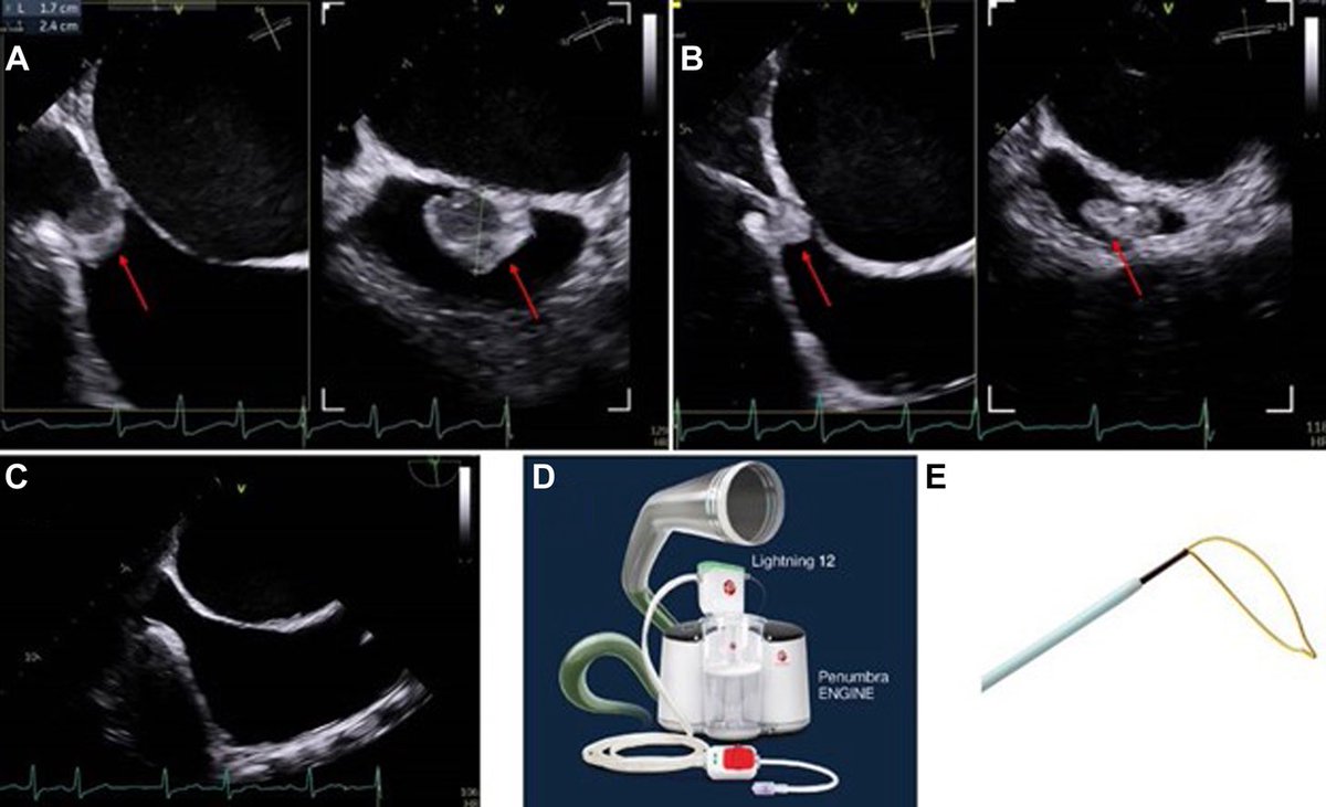 Abdulrahman Arabi (@abdarabi) on Twitter photo 🚨 New in JACC: the “QATAR” procedure — a innovation from our 🇶🇦 HH structural team.
Proud moment! 💪
<a href="/JACCJournals/">JACC Journals</a> <a href="/escardio/">European Society of Cardiology</a> @accmiddleeast <a href="/Saudi_Heart/">šàûdî hèàrt</a> @GIS_Cardiology @gulf_pcr <a href="/HMC_Qatar/">مؤسسة حمد الطبية</a> <a href="/AlhijjiM/">Mohammed Al-Hijji</a> <a href="/MohammedQintar/">Mohammed Qintar, MD MSc</a>
🔗 jacc.org/doi/10.1016/j.…
#StructuralHeart #Innovation 🚨 New in JACC: the “QATAR” procedure — a innovation from our 🇶🇦 HH structural team.
Proud moment! 💪
<a href="/JACCJournals/">JACC Journals</a> <a href="/escardio/">European Society of Cardiology</a> @accmiddleeast <a href="/Saudi_Heart/">šàûdî hèàrt</a> @GIS_Cardiology @gulf_pcr <a href="/HMC_Qatar/">مؤسسة حمد الطبية</a> <a href="/AlhijjiM/">Mohammed Al-Hijji</a> <a href="/MohammedQintar/">Mohammed Qintar, MD MSc</a>
🔗 jacc.org/doi/10.1016/j.…
#StructuralHeart #Innovation