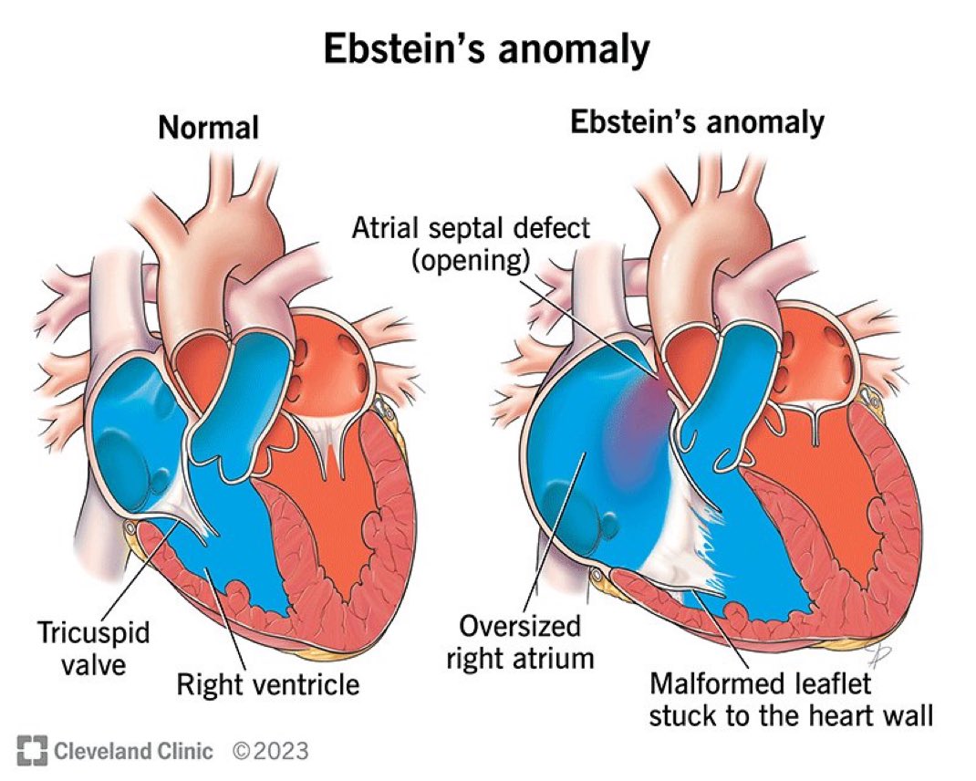 Ebstein's anomaly