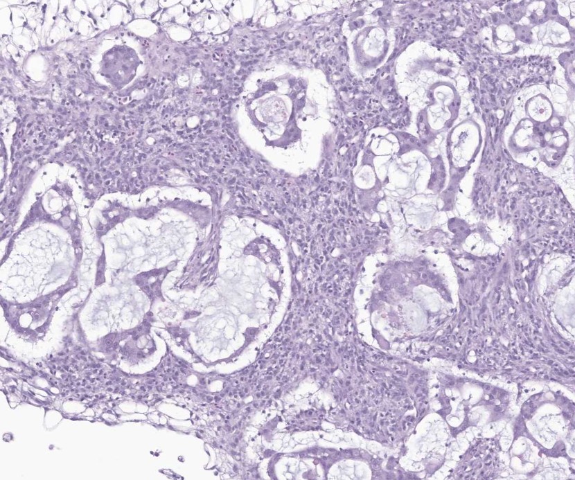 VetPathophile's tweet photo. Hey, Team #VetPath, it's Wednesday, we're halfway there!
What's the deal with these autopsy findings in a uterine mass from a fish?
❓Histopath features
❓Diagnosis https://t.co/ANGzibB3l4