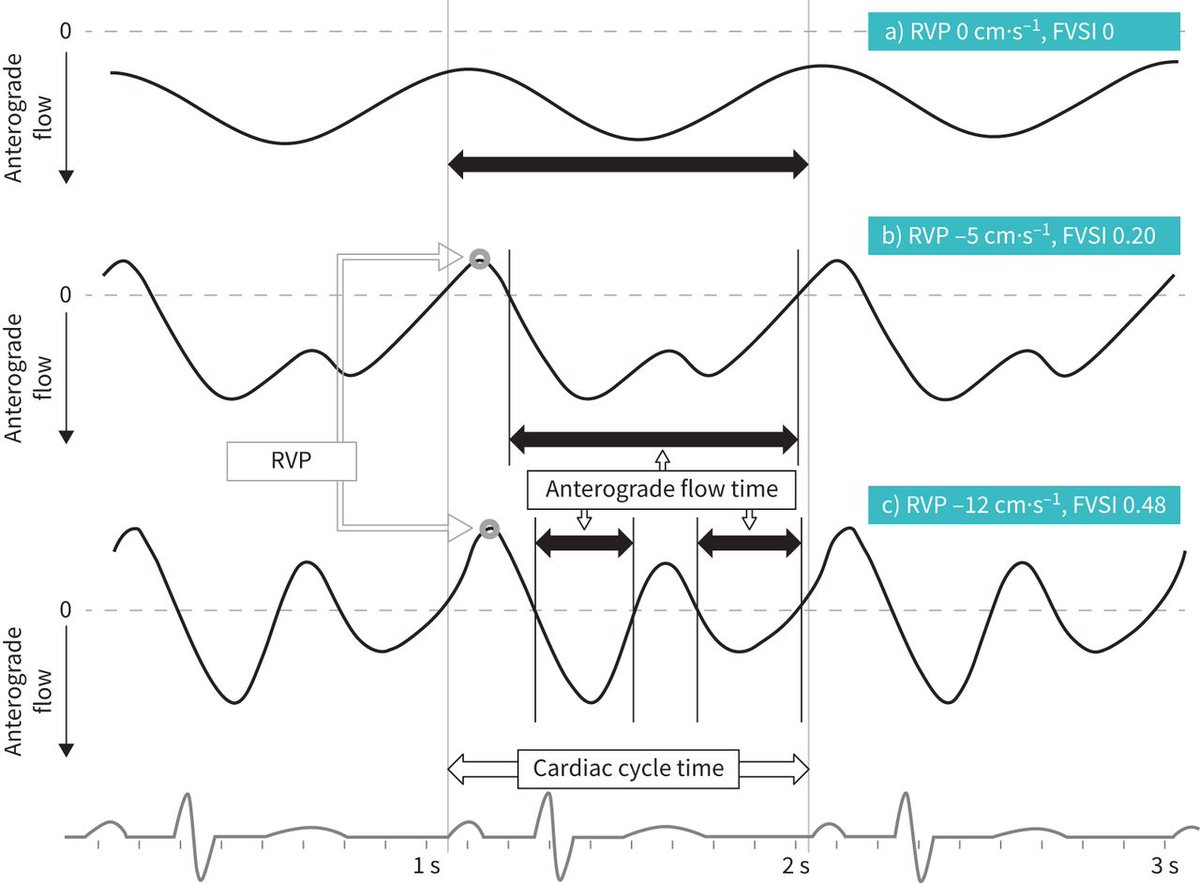 Proud to have collaborated with my close colleagues from Poitiers
"Femoral venous stasis index is a new non-invasive ultrasound tool that can accurately predict right atrial pressure and mortality in patients with PH" 
<a href="/SPLF_SocPneumo/">Société de Pneumologie de Langue Française (SPLF)</a> <a href="/pulmotension/">Pulmotension</a>  

bit.ly/3ZPpeF8