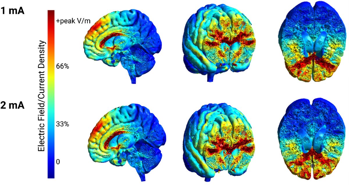 UTSWNeurology's tweet image. “High definition transcranial direct current stimulation as an intervention for cognitive deficits in Alzheimer&apos;s dementia: A randomized controlled trial” published by UTSW neurologists in The Journal of Prevention of Alzheimer&apos;s Disease. bit.ly/441wyj7

#brain #science