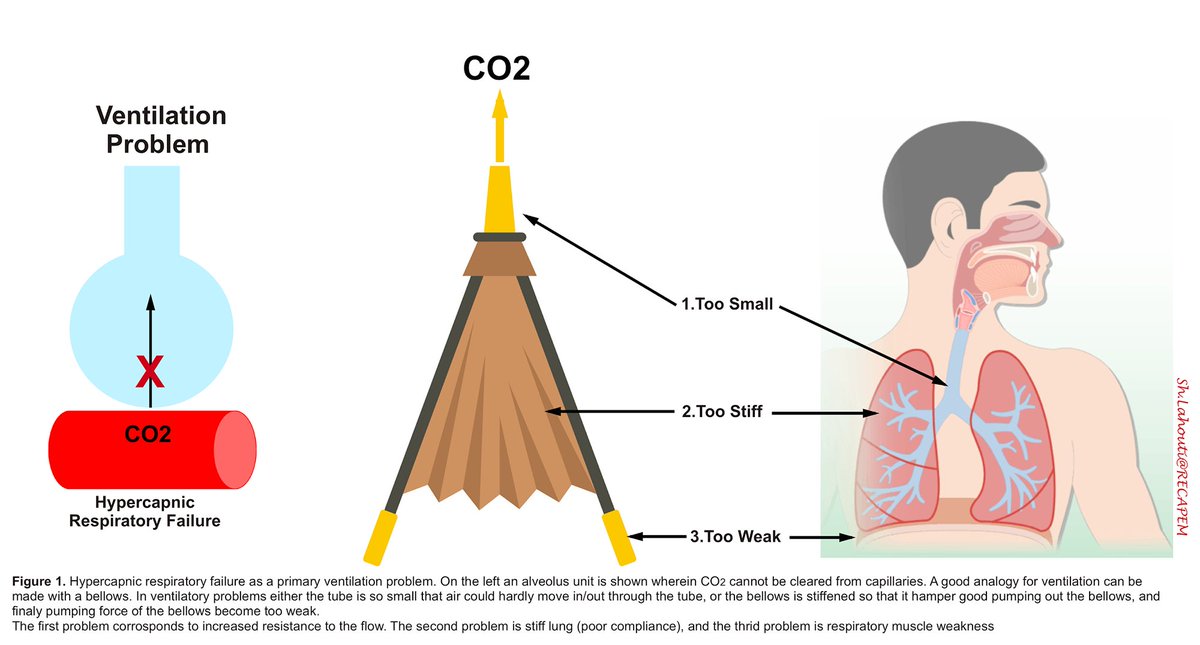 NephroP's tweet photo. Nice review on mechanical ventilation, particularly useful for new residents and fellows starting ICU rotation.
#FOAMed #FOAMcc #ICU 
🔗 https://t.co/f83K16sBK8 https://t.co/poaHaQcAoj