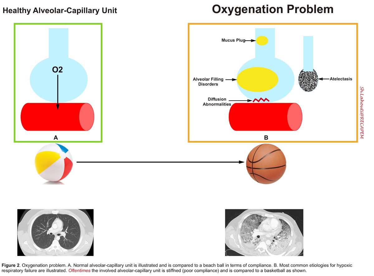 Nice review on mechanical ventilation, particularly useful for new residents and fellows starting ICU rotation.
#FOAMed #FOAMcc #ICU 
🔗 recapem.com/mechanical-ven…