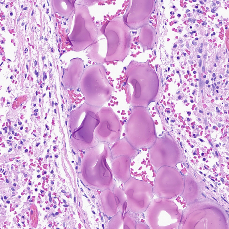 What's going on with this #meningioma? Have I discovered a funky new morphologic subtype?😄#pathology #neuropath #PathTwitter