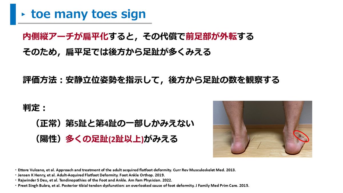 pt_inakano's tweet photo. 扁平足を評価するtoe many toes sign https://t.co/bQ6Fv7teML