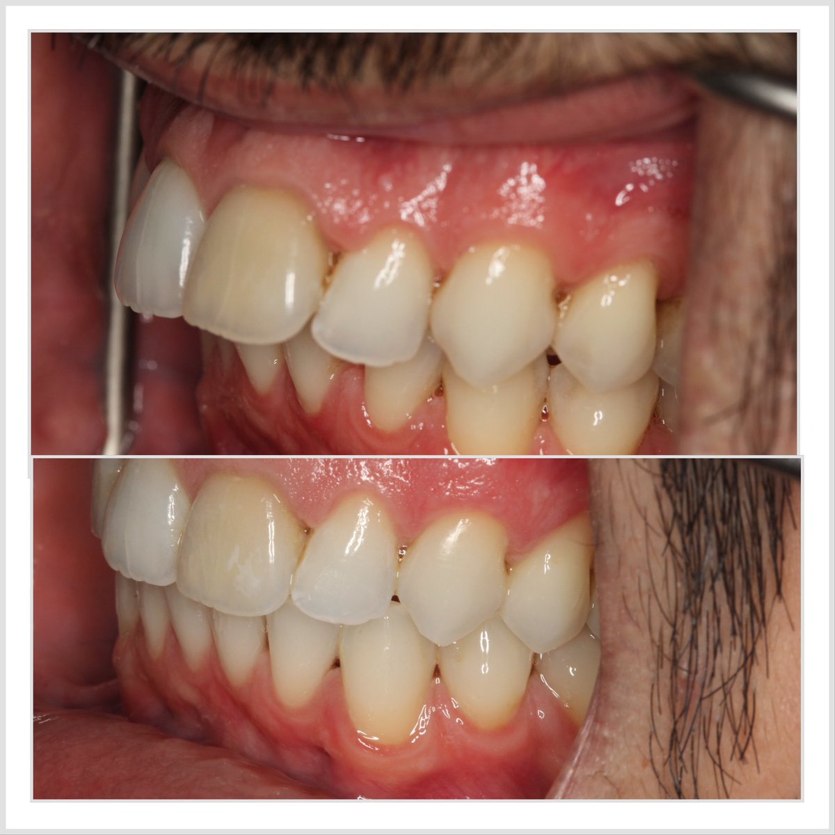 progresdent's tweet photo. A great Invisalign case here closing spaces and correcting a large overjet. Expertly planned by Dr Nissit Patel. #invisaligncomprehensive https://t.co/fTFEW1ZhrG
