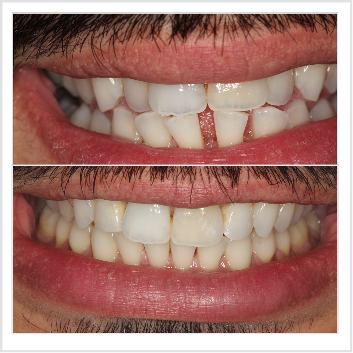 progresdent's tweet photo. A great Invisalign case here closing spaces and correcting a large overjet. Expertly planned by Dr Nissit Patel. #invisaligncomprehensive https://t.co/fTFEW1ZhrG