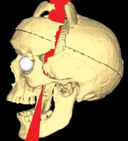 neuroloungepod's tweet image. Episode 48. 
Impact – The Tragedy of Traumatic Brain and Spinal Cord Injury
youtu.be/2RtWTQ3GNPY