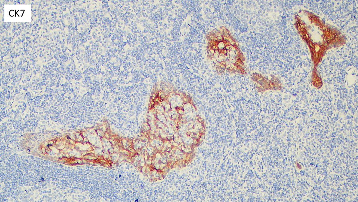 javidiparsijani's tweet photo. #benign #lymphadenopathy #epithelial #inclsion 
This is a young patient with no known history of malignancy &amp;cervical lymphadenopathy: There is exuberant epithelial inclusions of salivary gland type/origin in the lymph node. CK7 and p63 show preserved double layers.
#hemepath https://t.co/uW3yxSAEqL