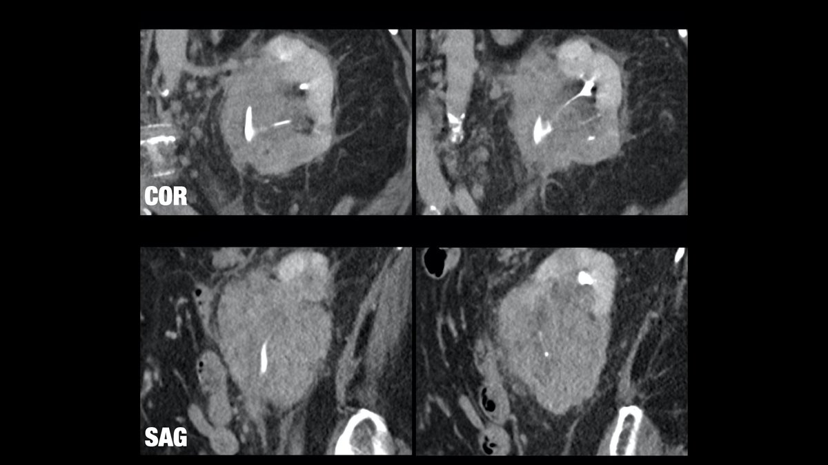 Daniel Souza (@danatsouza) on Twitter photo 78-year-old male patient presenting with an infiltrative renal mass encasing the collecting system, without causing hydronephrosis or caliectasis... can you guess the diagnosis? This is a REALLY tough one...
<a href="/BrighamRad/">Brigham and Women's Radiology</a> <a href="/FOAMrad/">FOAMrad</a> <a href="/SAR_RFS/">SAR Resident and Fellow Section</a> <a href="/futureradres/">Future Radiology Residents</a> <a href="/ARRS_Radiology/">ARRS</a> 78-year-old male patient presenting with an infiltrative renal mass encasing the collecting system, without causing hydronephrosis or caliectasis... can you guess the diagnosis? This is a REALLY tough one...
<a href="/BrighamRad/">Brigham and Women's Radiology</a> <a href="/FOAMrad/">FOAMrad</a> <a href="/SAR_RFS/">SAR Resident and Fellow Section</a> <a href="/futureradres/">Future Radiology Residents</a> <a href="/ARRS_Radiology/">ARRS</a>