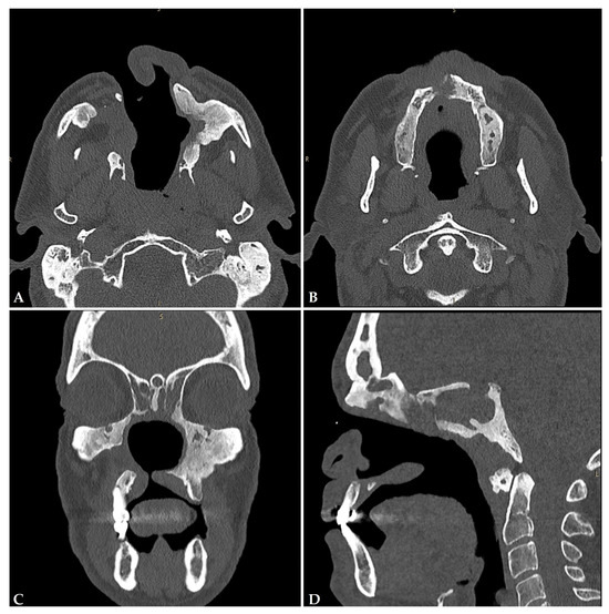 JCM_MDPI's tweet photo. #mdpijcm
#Editor’s Choice Paper🙌
#HighlyReviewed
Cocaine- and Levamisole-Induced #Vasculitis: Defining the Spectrum of #Autoimmune Manifestations
📌https://t.co/Rp7X2uURM5
🏫University of Padua
by Luca Iorio et al. @UnitPadova @FedeDavanzo @roberto_padoan  @MediPharma_MDPI https://t.co/sV3KkjOcXZ
