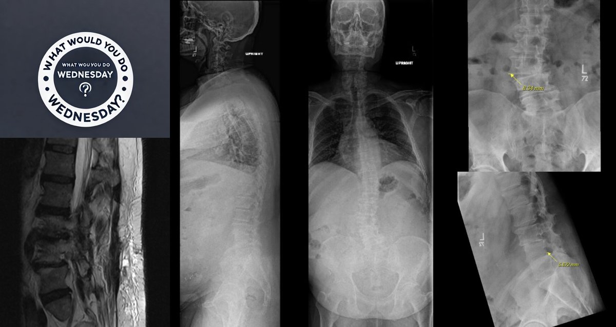 spinesection's tweet image. 🧠 What Would You Do Wednesday? 🧠
🧍♂️ 54-year-old patient with left leg pain that’s:
🔹 Worsened by standing and walking, L3 distribution
🔹 Improved with sitting or lying down
🔹 Persistent despite maximal conservative therapy (PT, ESI, meds)
🔹 Now causing significant impact on…