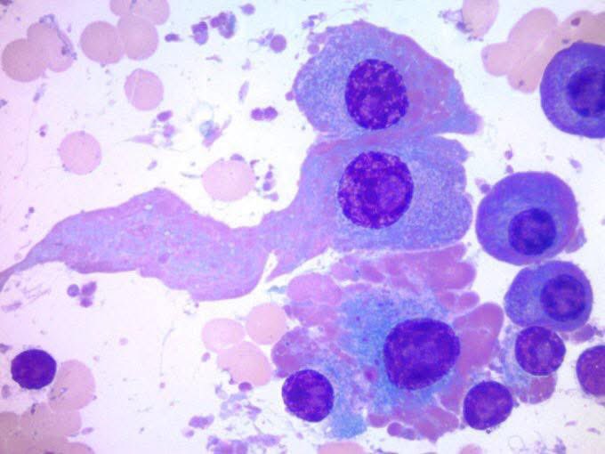 Kalyani Bambal (@kriyer68) on Twitter photo If I were a cell I would be a “flame cell” cuz I am hot too.
📸Chadophil.
🔥🔥💥💥💥<a href="/smlungpathguy/">Sanjay Mukhopadhyay</a> <a href="/JMGardnerMD/">Jerad Gardner, MD</a> <a href="/pepeheffernan/">Pepe Jiménez Heffernan</a> <a href="/DanGrahamMD/">Dan Graham</a> <a href="/MirunaPopescu13/">Miruna Popescu, MD</a> <a href="/Venkateshgilly2/">Venkatesh Dhanasekaran</a> <a href="/AnupamaArya12/">Anupama Arya</a> <a href="/RibianszkyA/">Annamária Ribiánszky, MD</a> <a href="/Dr_Brian_Cox/">Brian Cox, MD, MAS</a> <a href="/Path4People/">Jay Hwang</a> If I were a cell I would be a “flame cell” cuz I am hot too.
📸Chadophil.
🔥🔥💥💥💥<a href="/smlungpathguy/">Sanjay Mukhopadhyay</a> <a href="/JMGardnerMD/">Jerad Gardner, MD</a> <a href="/pepeheffernan/">Pepe Jiménez Heffernan</a> <a href="/DanGrahamMD/">Dan Graham</a> <a href="/MirunaPopescu13/">Miruna Popescu, MD</a> <a href="/Venkateshgilly2/">Venkatesh Dhanasekaran</a> <a href="/AnupamaArya12/">Anupama Arya</a> <a href="/RibianszkyA/">Annamária Ribiánszky, MD</a> <a href="/Dr_Brian_Cox/">Brian Cox, MD, MAS</a> <a href="/Path4People/">Jay Hwang</a>