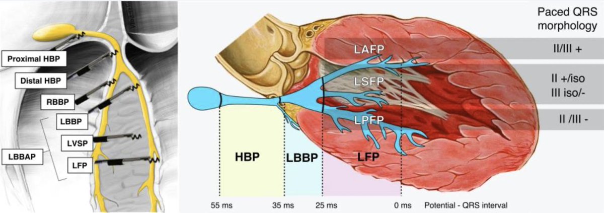 EHRAPresident (@ehrapresident) on Twitter photo CSP implies direct activation of the conduction system by the pacing stimulus. This includes pacing at the level of His bundle or its major branches or their further ramifications including distal Purkinje fibres.
🖇️tinyurl.com/bde8vdw6
#EHRAtopicweek #Epeeps <a href="/EuropaceEiC/">Europace Editor-in-Chief</a> CSP implies direct activation of the conduction system by the pacing stimulus. This includes pacing at the level of His bundle or its major branches or their further ramifications including distal Purkinje fibres.
🖇️tinyurl.com/bde8vdw6
#EHRAtopicweek #Epeeps <a href="/EuropaceEiC/">Europace Editor-in-Chief</a>