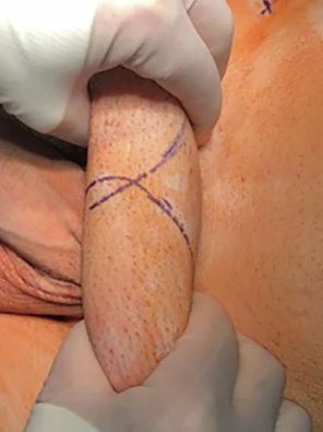 Penile length preservation in #penileprosthesis placement: tips &amp; tricks👉rdcu.be/euAVr

<a href="/pramodkdr/">Pramod Krishnappa</a> <a href="/enriquelledoga1/">enrique lledo garcia</a> <a href="/imoncada/">Ignacio Moncada</a>