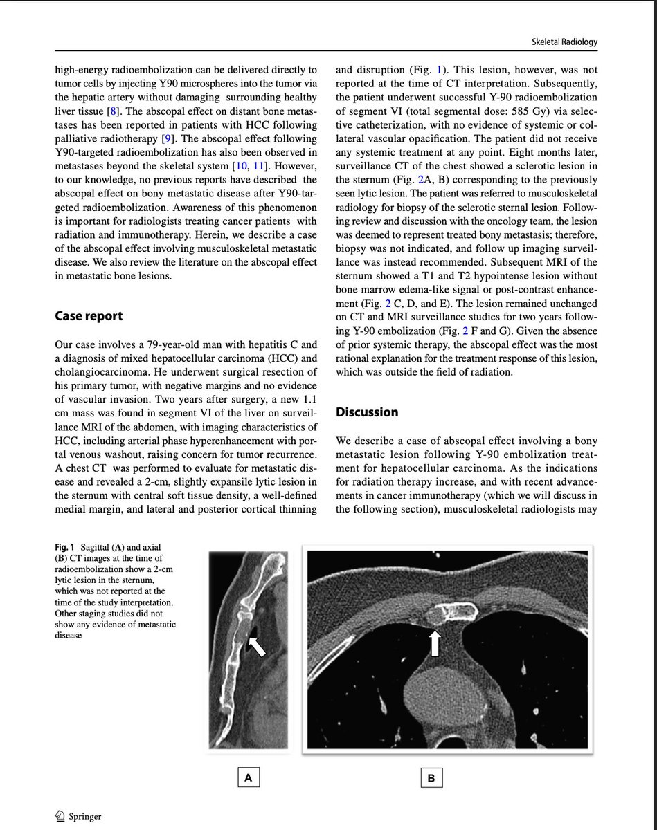 Where radiology meets immunology:

Radiation-induced regression of distant skeletal lesions __ the abscopal effect is rare but real.                                                             

Recognizing it on imaging holds important clinical significance.

#Radiology