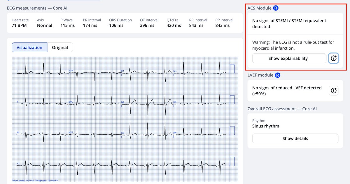 Robert Herman, MD (@roberthermanmd) on Twitter photo <a href="/amalmattu/">Amal Mattu</a> Queen of Hearts on point, yet again! Obviously ECG or AI ECG is not a replacement of serial testing... <a href="/amalmattu/">Amal Mattu</a> Queen of Hearts on point, yet again! Obviously ECG or AI ECG is not a replacement of serial testing...