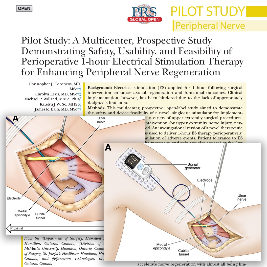 PRSGlobalOpen's tweet image. ⚡ Could a simple 1-hour therapy boost nerve healing after surgery?
#PRSGlobalOpen shares new findings on a novel, easy-to-use stimulator that delivered safe, well-tolerated electrical stimulation during surgery, without disrupting workflow.
👉 Read it: l8r.it/q5oh