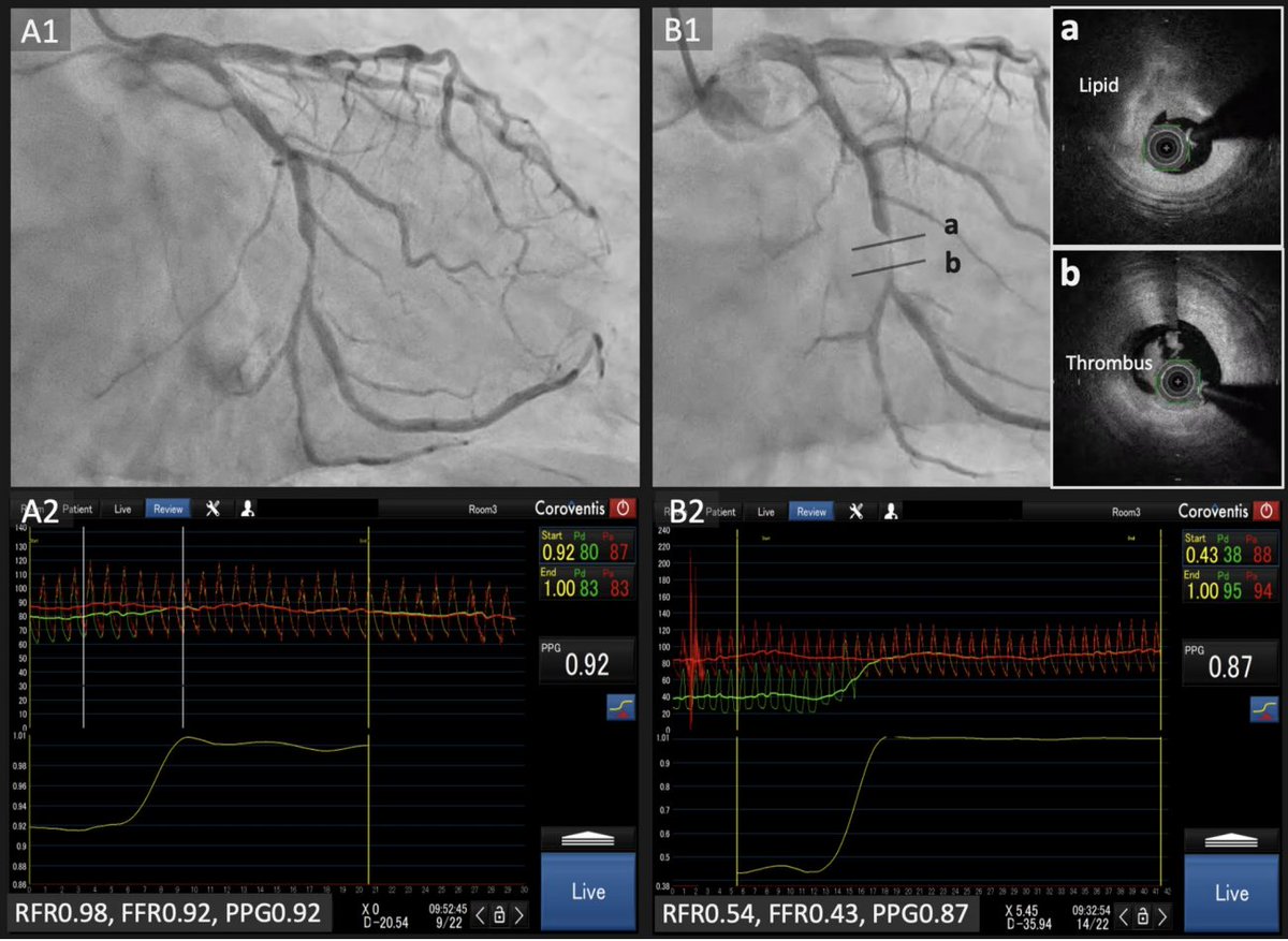 ColletCarlos's tweet photo. Could #PPG be the key to identifying vulnerable plaques with precision? 🔬🧠

Fascinating insights from the pioneers of PPG  in Japan 🇯🇵

The future of coronary imaging might be closer than we think. @PCRonline @TCTMD 

https://t.co/hfY4UbSgwy https://t.co/xkX8VhD7H9