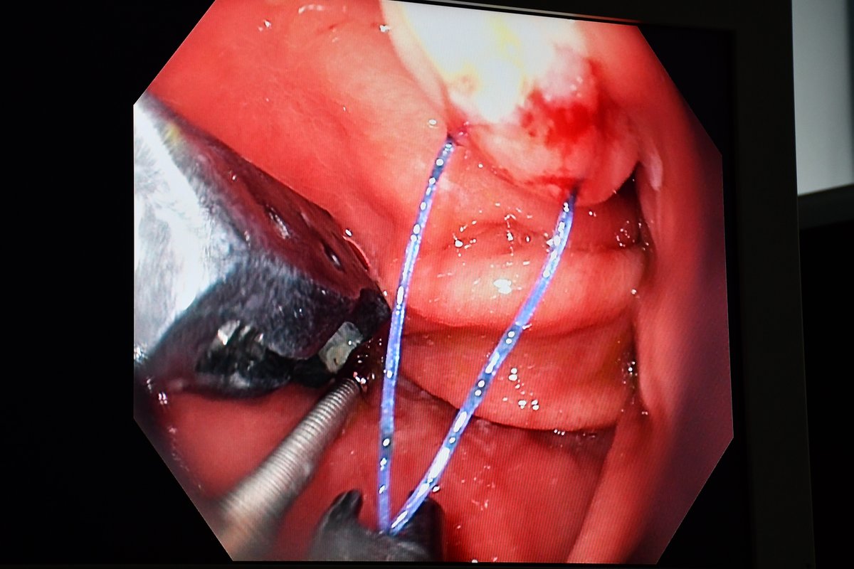 Moderní endoskopická léčba obezity už i na Moravě! 🤩 A to díky lékařům z našeho Gastroenterologického a hepatologického oddělení. O endoskopické sleeve gastroplastice se dočtete na webu 👉 1url.cz/7JEwv