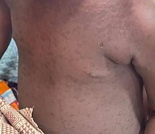 A measles outbreak has claimed the lives of two infants in Alito Sub-county, Kole District, while seven other children remain in critical condition.

The incident has raised the attention of health authorities, who have swiftly responded and are working around the clock to