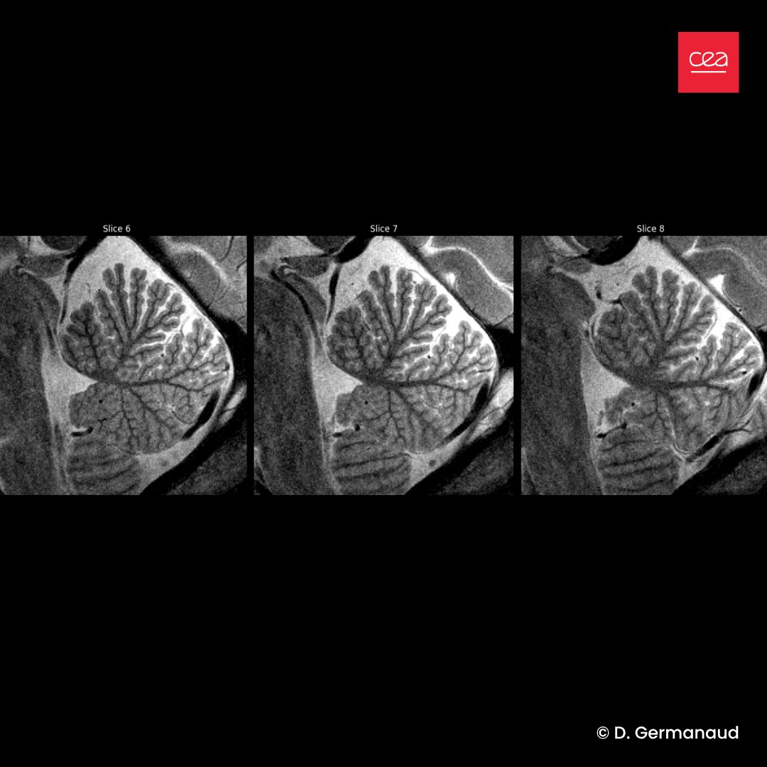 #Cerveau🧠| Le cerveau d’un enfant n'a jamais été aussi précis🔎

Jusqu’ici, l’IRM à ultra-haut champ 7 teslas était réservé aux adultes.
Les équipes ont réussi à adapter cette technologie pour observer le 🧠 en plein développement chez l’enfant.
Plus (+)👉bit.ly/3I8UolX