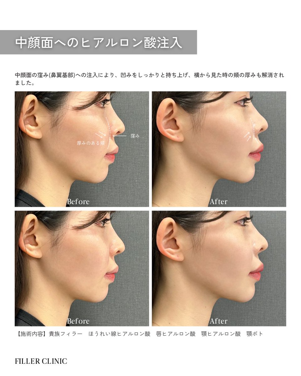 実践フィラー注入テクニック Amazon.co.jp: 実践フィラー注入テクニック : 岩城佳津美: 本