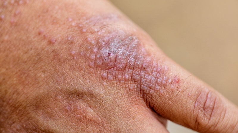 Guidelines in Practice from Medscape (@ginp_medscape) on Twitter photo Hand and Foot Eczema
ms.spr.ly/6013SF3IV Hand and Foot Eczema
ms.spr.ly/6013SF3IV