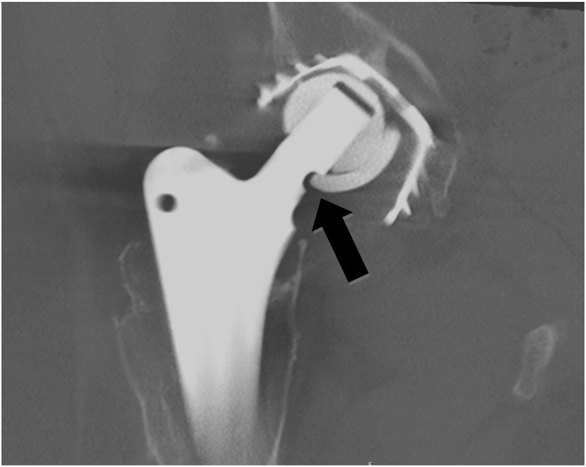 CASE REPORT: The Femoral Neck-Bite Sign: A Radiographic Indicator of Catastrophic Sandwich Liner Failure in Total Hip Arthroplasty

Fractured ceramic... femoral neck notching... osteolysis... OH MY!  

See how this was managed in this unique case report: 
arthroplastytoday.org/article/S2352-…