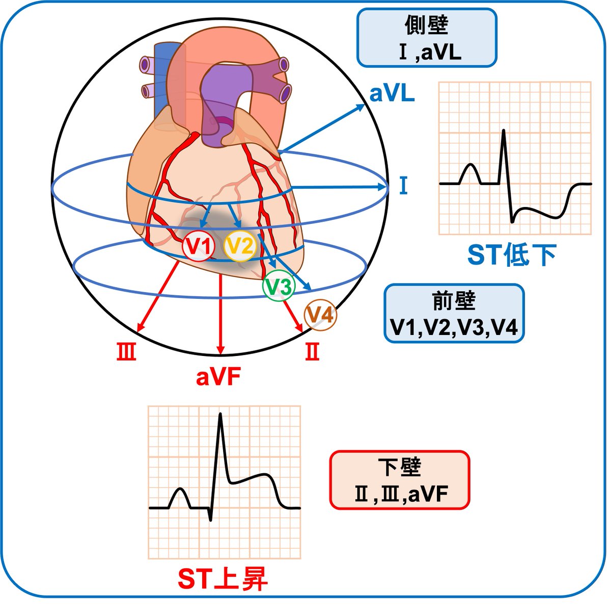 右冠動脈閉塞による下壁梗塞のST変化