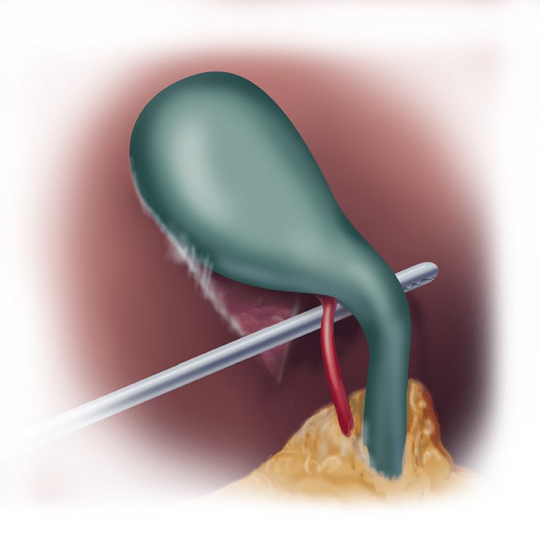 drteoa's tweet photo. 🔪 6 estrategias para prevenir lesión de vía biliar en colecistectomía laparoscópica 

1️⃣ Visión Crítica de Seguridad (CVS)
Debe cumplir 3 criterios:
• Triángulo hepatocístico limpio
• Despegue del tercio inferior de la vesícula
• Solo 2 estructuras ingresan a la vesícula https://t.co/waacQQJIDx