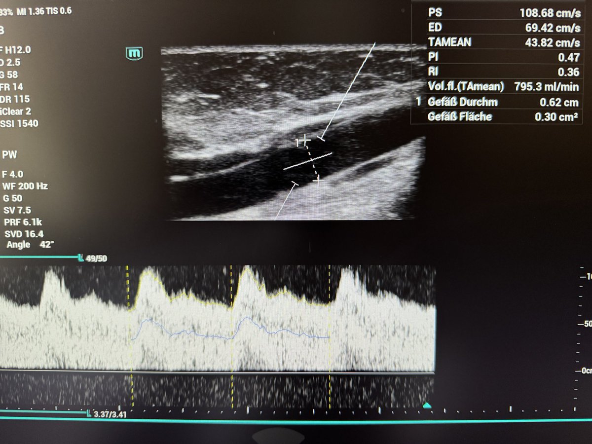 📣 Dialysis nurses, nephrologists and other HD Vascular Access enthusiasts - 4 w/o matured #Snuffbox #AVF - would you transpose, elevate, lipectomy, liposuction (whatever 
-bring the vein close to the skin), or leave it to nephrologist who insists they do cannulae deep veins?