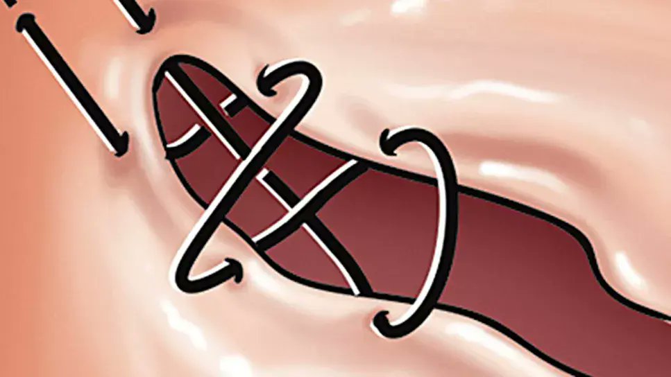 CleClinicMD's tweet image. Researchers have demonstrated that adding a figure-of-8 stitch to conventional bicuspid aortic valve repair methods is safe and achieves good long-term outcomes: cle.clinic/3Pc6QBZ