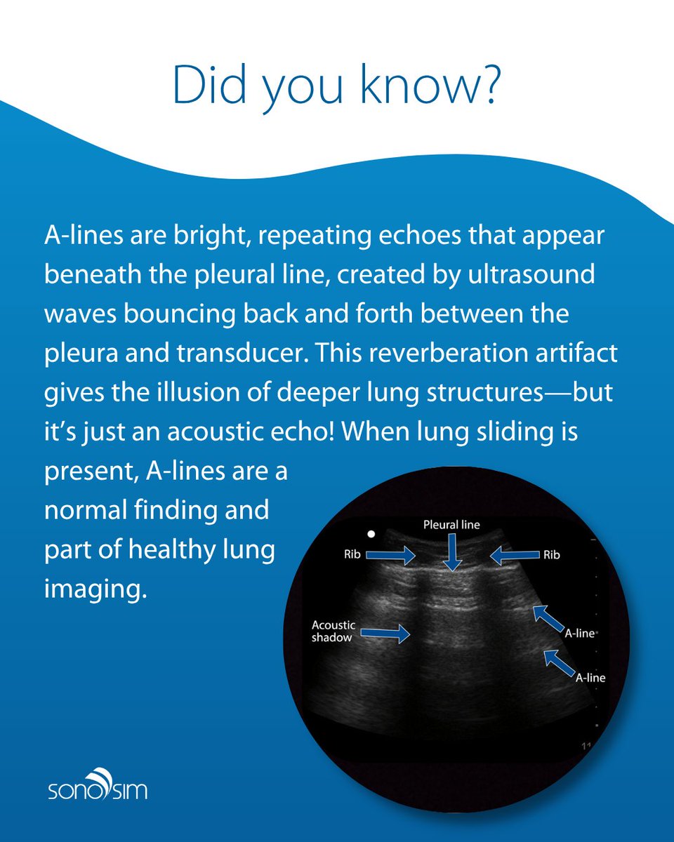 Not everything you see on an ultrasound is what it seems! Some patterns can be deceiving, but they still provide valuable clues about lung health. 🫁 

#sonosim #ultrasoundtraining #lungultrasound #pulmonary #ultrasoundtraining