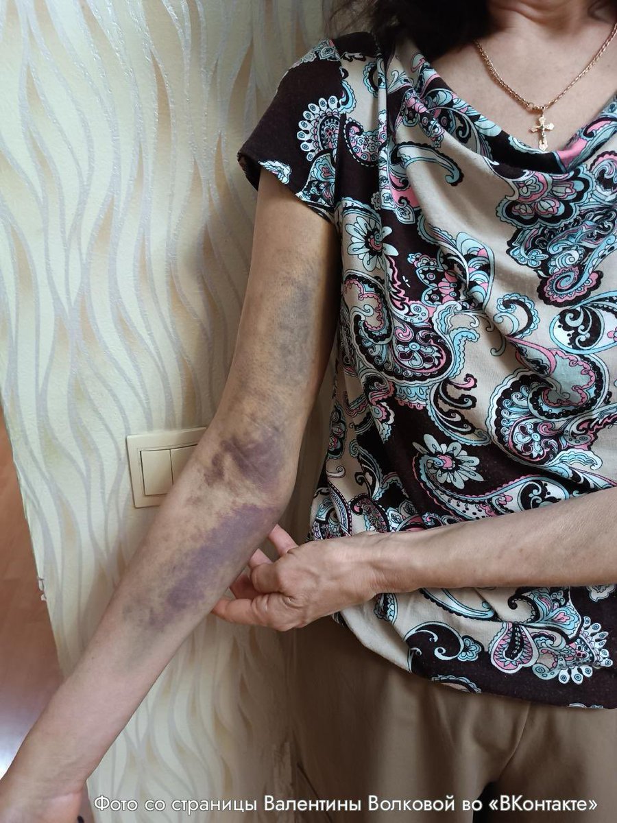 В Рязани полицейские сломали руку пенсионерке, приняв ее за закладчицу — читайте в треде