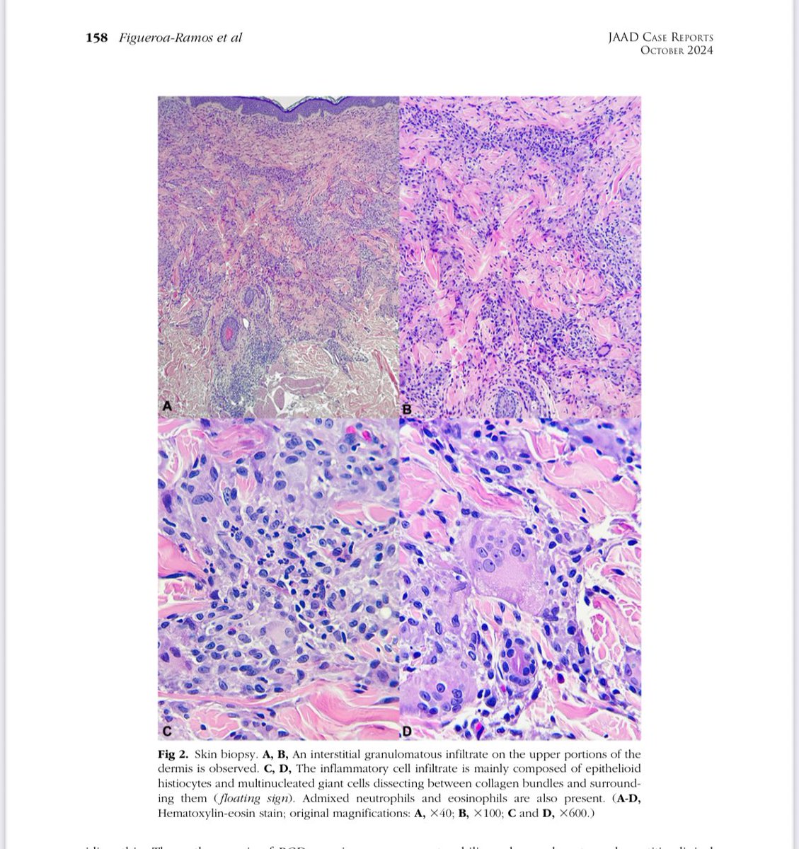 Me han informado de la publicación de este caso que YO DIAGNOSTIQUÉ HISTOLÓGICAMENTE en el instituto y que SIN reconocimiento a patología lo publicaron dermatólogos. Ellos no sabían que era. Se robaron hasta las laminillas.  Y ustedes se quejan del robo de tuits🤪
#dermatología