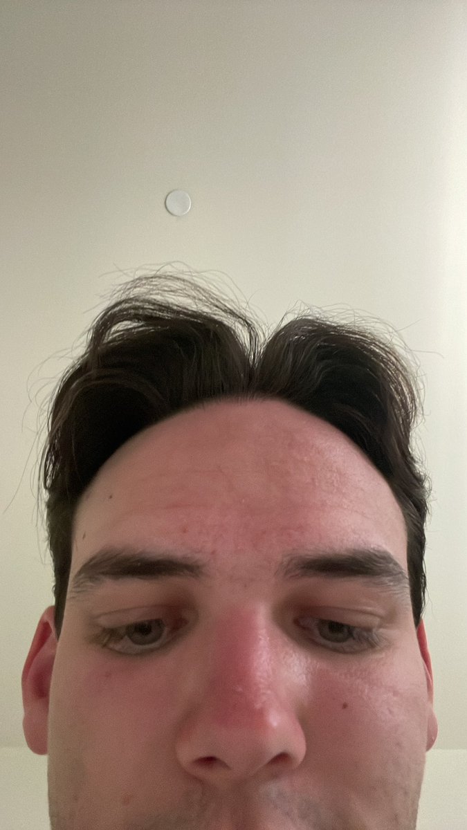 I never learn my lesson about sunscreen