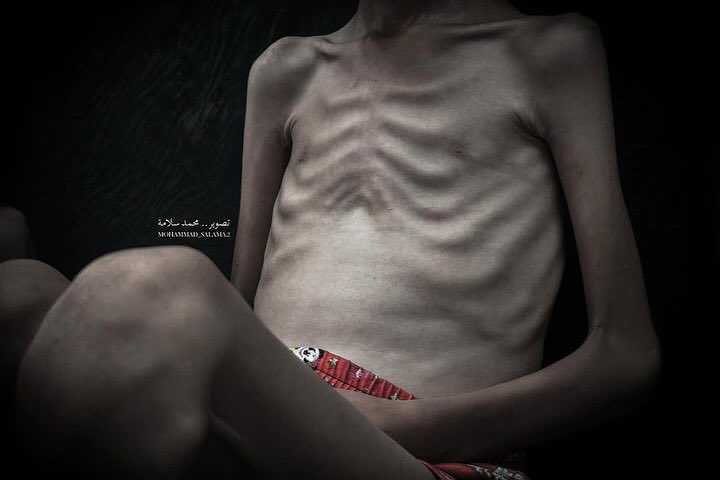 Amal is one of thousands of children in Gaza facing the threat of hunger and malnutrition under a suffocating blockade and severe shortages of food, water, and medicine.
Her frail body tells the story of a childhood drained behind a tent of displacement and beneath the rubble of