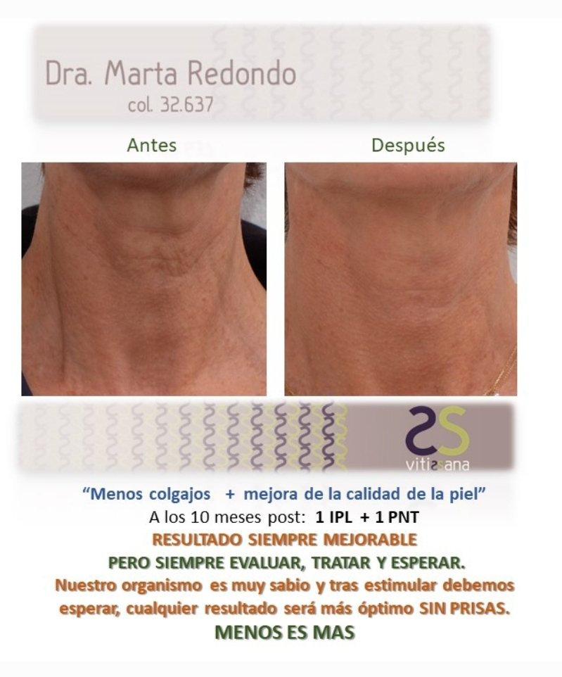 VitisSana's tweet photo. En #VitisSana "menos es más " y siempre será nuestro emblema.
Hoy os presentamos un caso de #CUELLO: zona delicada, y ardua tarea mantenerlo en óptimo estado. Lo solemos descuidar en nuestras rutinas diarias y a la larga el decalaje entre cara y rostro muestra ese "abandono". https://t.co/mVXQTmGuA4
