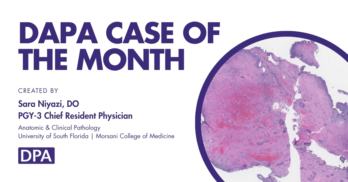 A 28-year-old female presents with progressive exertional dyspnea and intermittent episodes of lightheadedness. Transthoracic echocardiography demonstrates a mobile, pedunculated mass in the left atrium. What is the diagnosis? 

Contributor: Sara Niyazi 

zurl.co/28sRe