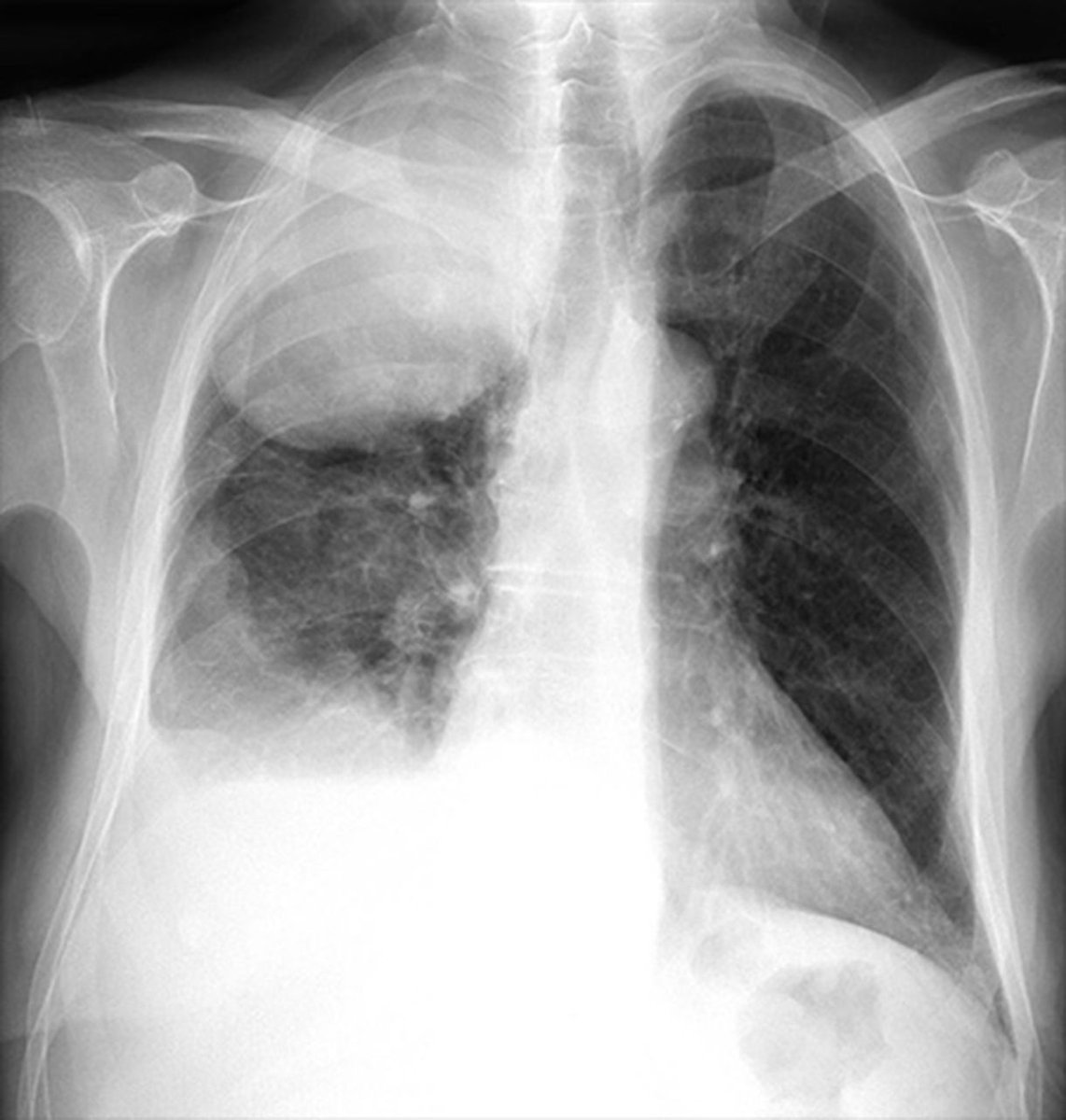 CHEST X-RAY 15: Describe this chest X-ray. What is the likely diagnosis? See answer buff.ly/3E7pV5t