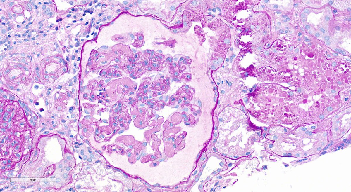 Pediatric anti-phospholipid syndrome (APS) is a rare autoimmune inflammatory disorder resulting in recurrent vascular thrombosis w/serious clinical implications. Read these Clinical Insights into pediatric APS nephropathy.
link.springer.com/article/10.100…