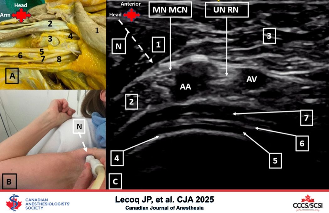 Brachial plexus block at the level of the humeral head: a proof-of-concept observational cadaver and clinical study - Canadian Journal of Anesthesia #CJA #Anesthesia #Anesthesiology buff.ly/Y7xSdRP