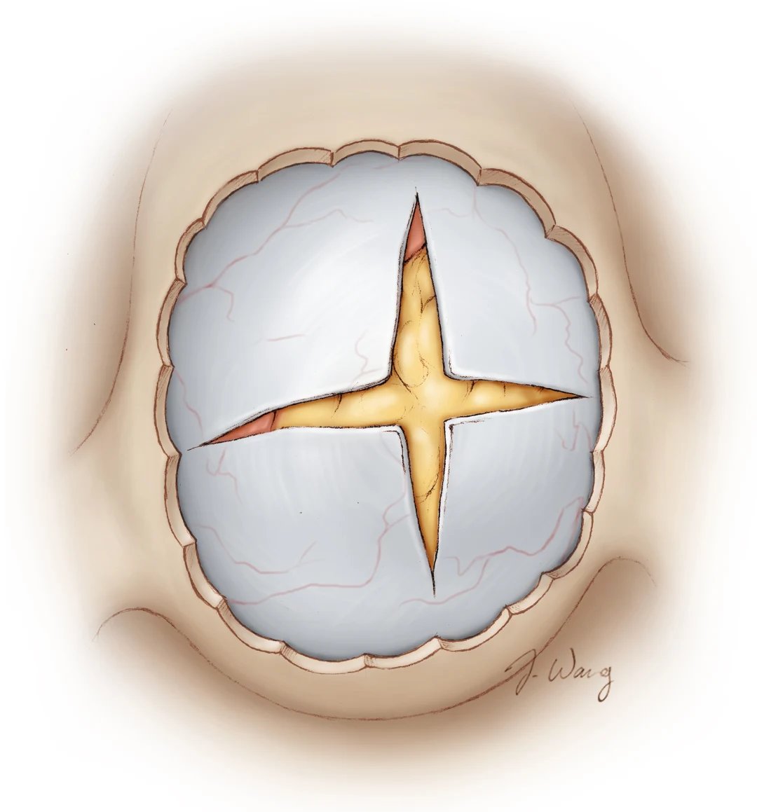 Why is autologous fat used to pack the resection cavity after pituitary tumor removal, and what complications can arise if the sella is overpacked? 

#Neurosurgery #EndoscopicSurgery #PituitaryTumor #Neuroanatomy