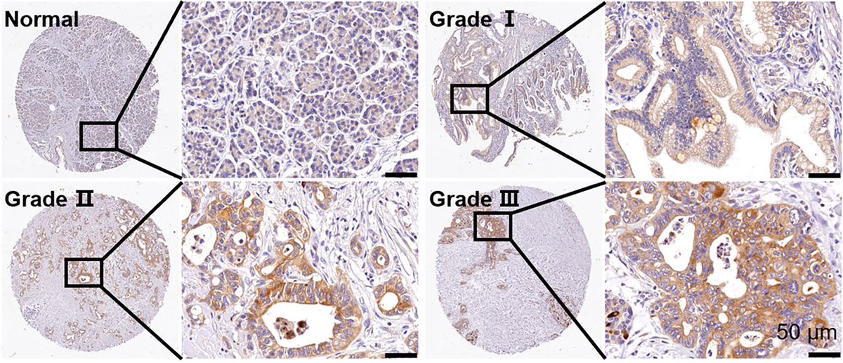 PancreaticCell's tweet image. In this @CellReports study, scientists showed that increased expression of cingulin (CGN) promoted pancreatic acinar-to-ductal metaplasia and CGN is progressively upregulated during #PDAC initiation and progression.
👉 bit.ly/44LKCPh