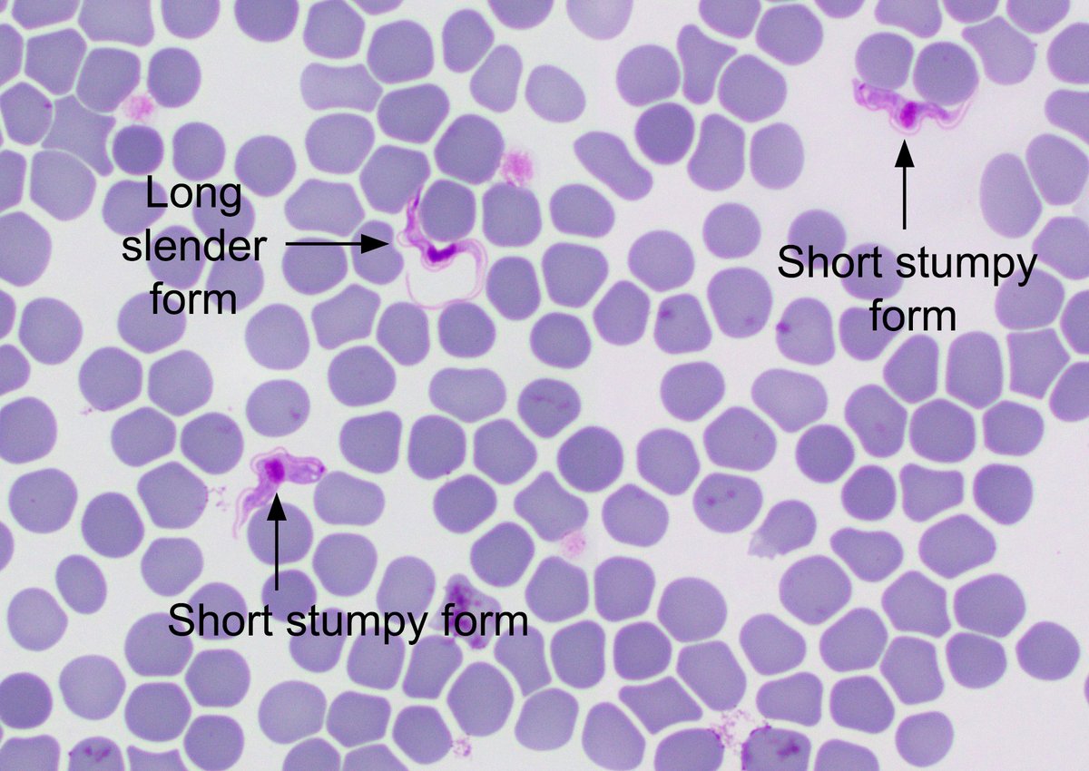 ParasiteGal's tweet photo. The answer to the #Parasite Case 780 is up: Trypanosoma brucei causing Human African Trypanosomiasis (HAT). Check out the full discussion on my blog, with pointers on what to look for in clinical cases. Thanks to Dr. Mutnal for this classic case! https://t.co/h3goiazSLn https://t.co/DFJlHoHKV3