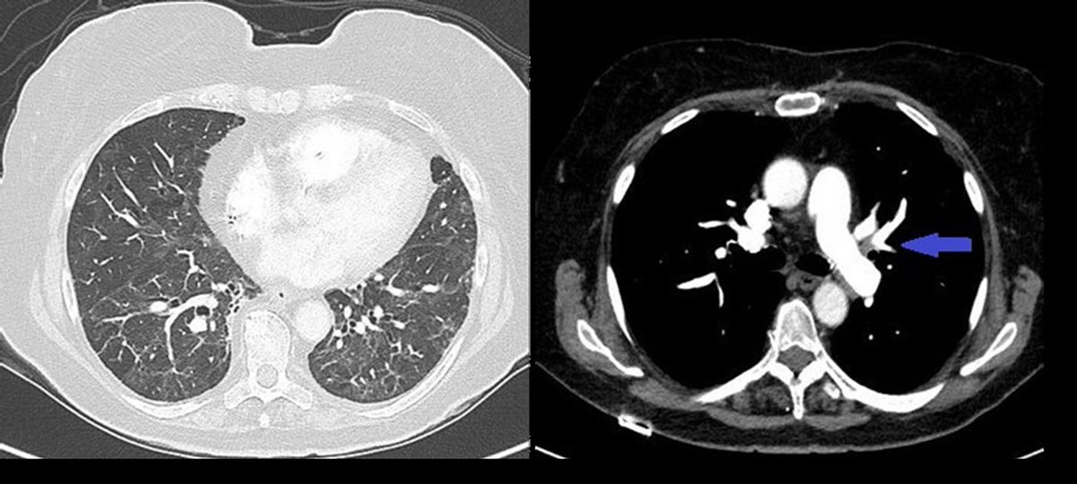 ⚠️ Overlapping signs of infective endocarditis (IE) and #COVID19 pneumonia can delay diagnosis—especially in elderly, comorbid patients. Clinicians should keep a low threshold for bedside echo in septic patients post-COVID-19. #Endocarditis #EchoFirst
🔗 doi.org/10.1093/ehjimp…
