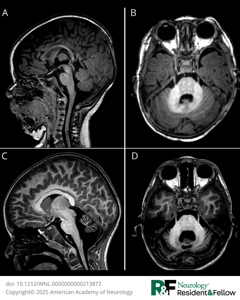 Teaching NeuroImage: Cortical DWI Hyperintensity, Cerebellar Atrophy, and Presentation With Prolonged Postictal Hemiparesis Suggest CACNA1A-Related Disorder hubs.la/Q03vN5vX0
